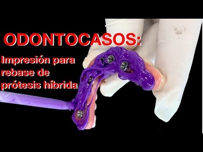 Impresión con silicona  para rebase de híbrida con desajuste de tejidos blandos.